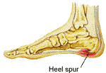 Heel Pain Treatment