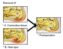 Heel Pain Treatment