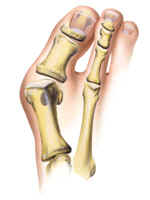 bunion