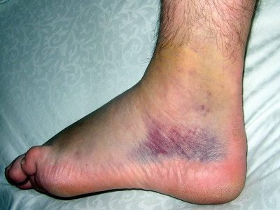 sprained-ankle