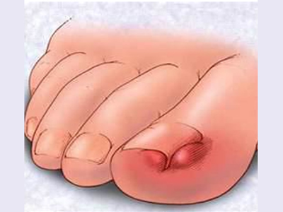 Ingrown Toenail problems