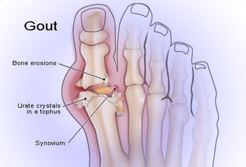Have you ever heard of Gout