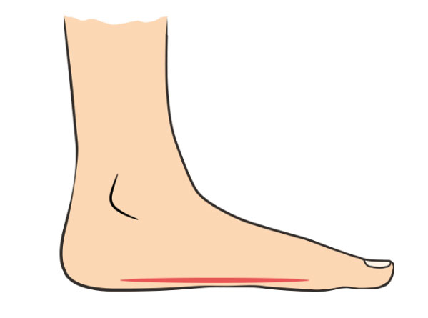 Progressive Flatfoot 