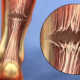 Achilles Tendon Rupture