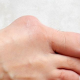 Benefits of Getting Bunion Removal Surgery