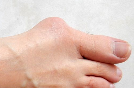 Benefits of Getting Bunion Removal Surgery