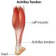 Types Of Achilles Tendon Repair Surgery