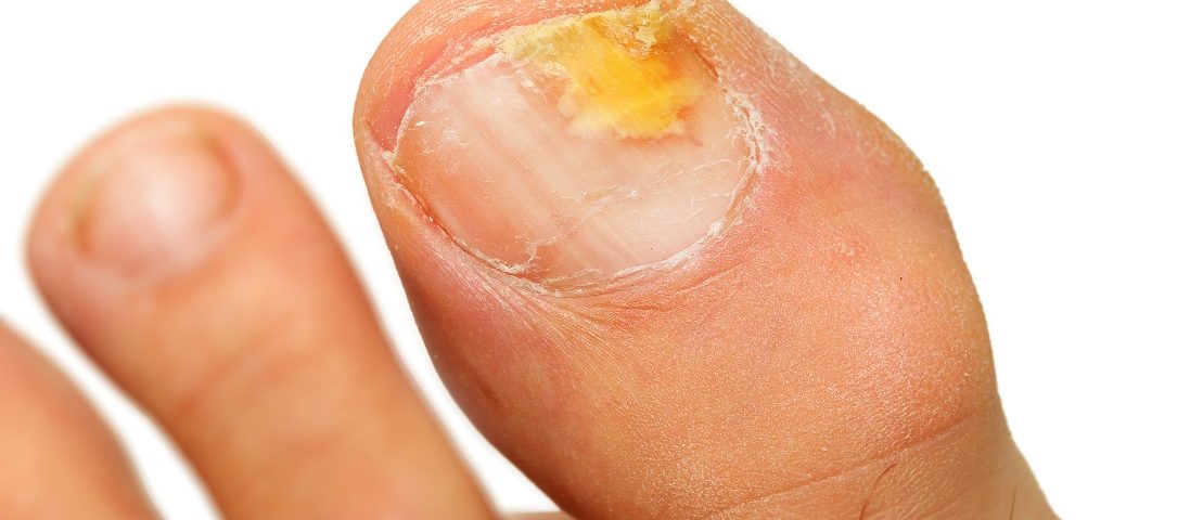 Toe Fungus