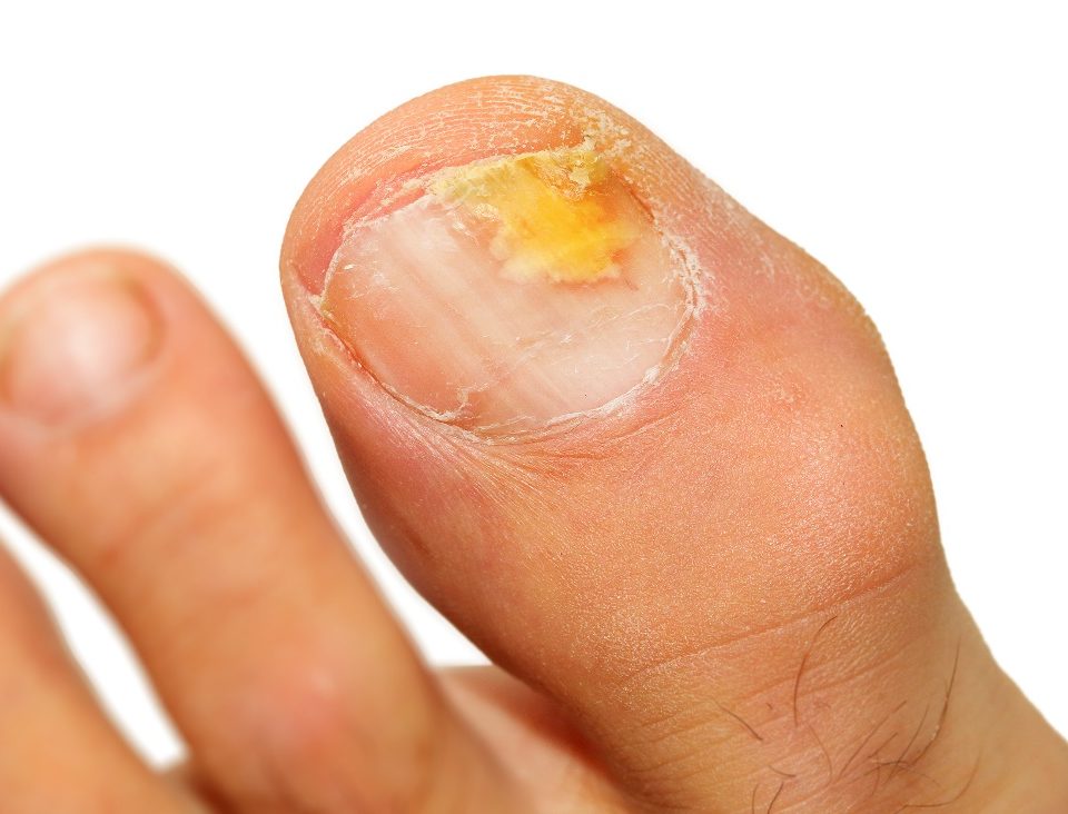 Toe Fungus