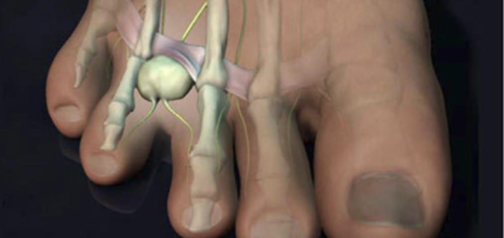 Morton's Neuroma