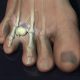 Morton's Neuroma