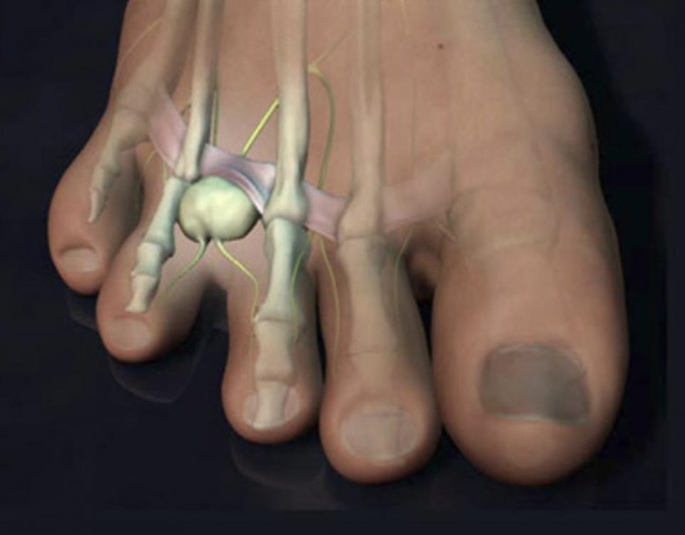 Morton's Neuroma