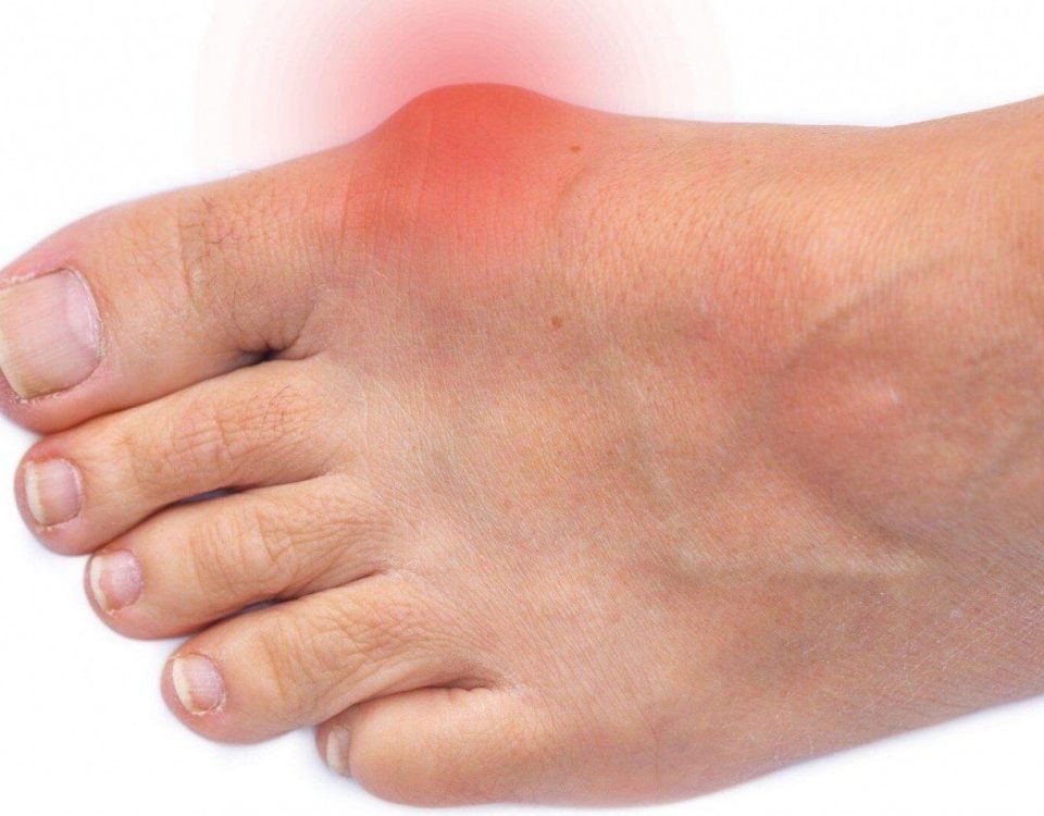 Banishing Bunion Pain