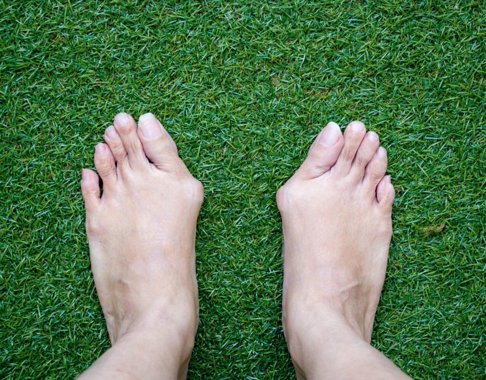 Bunion Surgery
