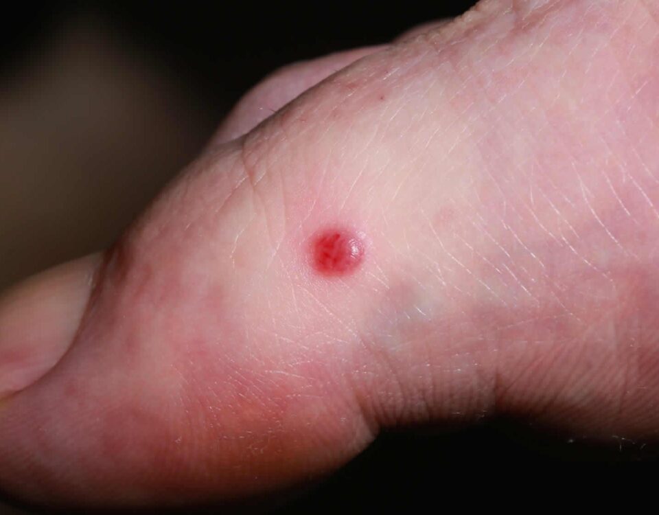 Skin lesions