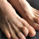 The Benefits of Hammer Toe Surgery
