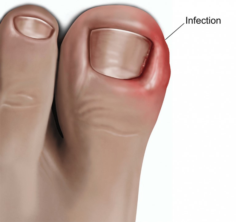Dealing with Painful Ingrown Toenails